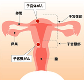 子宮頸がんと子宮体がんの基礎知識 図解